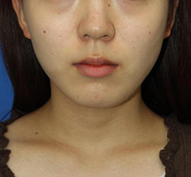 20代女性の顔の脂肪吸引  After 症例写真