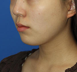 20代女性の顔の脂肪吸引  After 症例写真