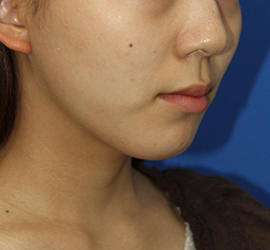 20代女性の顔の脂肪吸引  After 症例写真