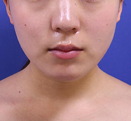 20代女性の顔の脂肪吸引  Before 症例写真