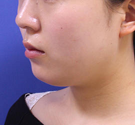 20代女性の顔の脂肪吸引  Before 症例写真