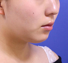 20代女性の顔の脂肪吸引  Before 症例写真
