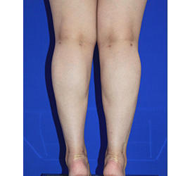 30代女性のボトックス（ふくらはぎ） After 症例写真