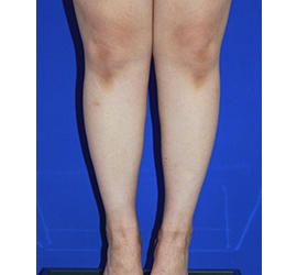 30代女性の脂肪吸引 After 症例写真