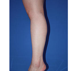 30代女性の脂肪吸引 Before 症例写真