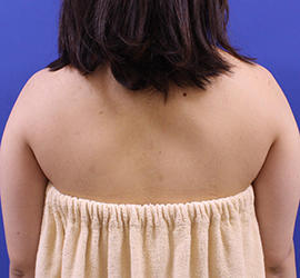 20代女性の脂肪吸引 Before 症例写真