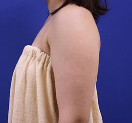 20代女性の脂肪吸引 Before 症例写真