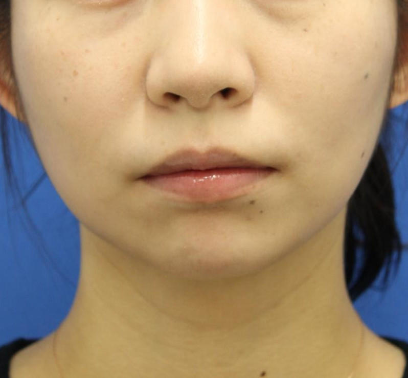 20代女性の顔の脂肪吸引 After 症例写真