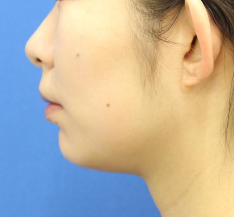 20代女性のバッカルファット除去 After 症例写真