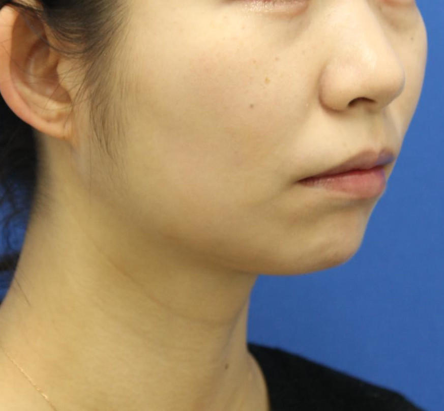 20代女性のバッカルファット除去 After 症例写真