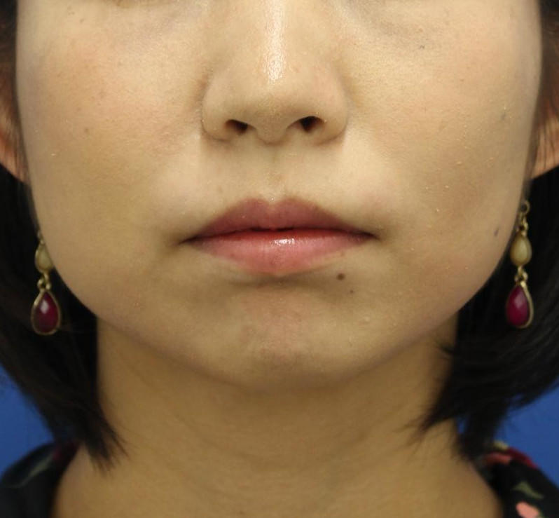 20代女性の顔の脂肪吸引 Before 症例写真