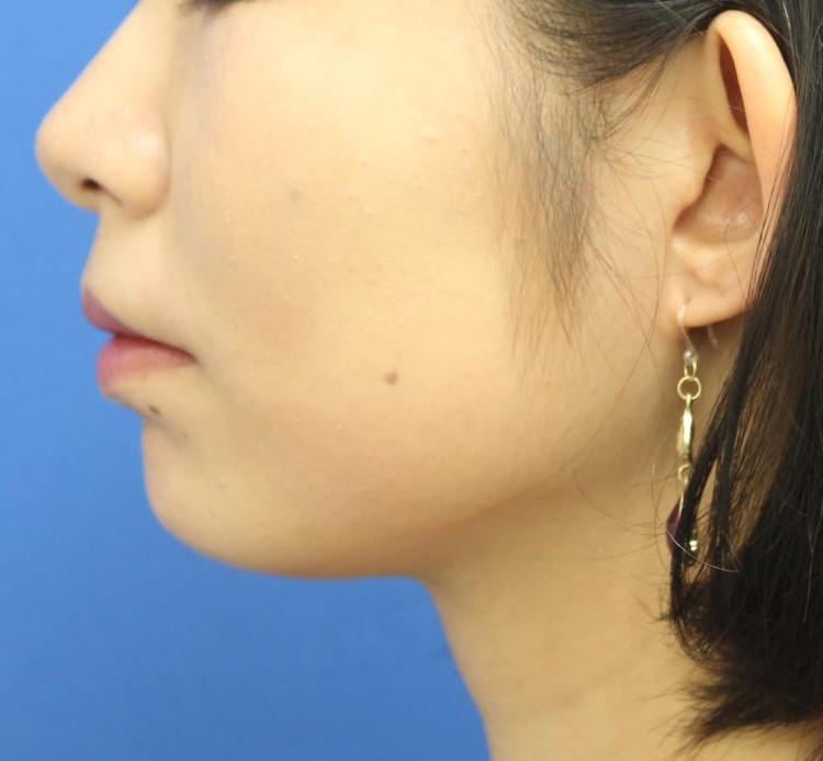 20代女性のバッカルファット除去 Before 症例写真