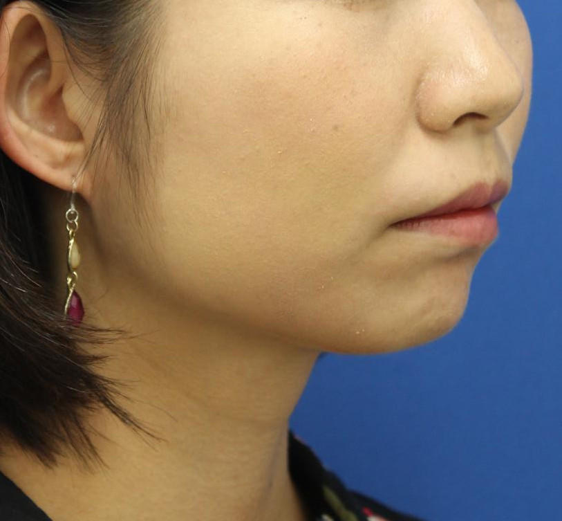 20代女性のバッカルファット除去 Before 症例写真