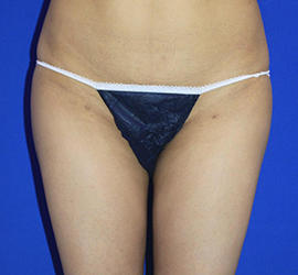 20代女性の脂肪吸引 After 症例写真