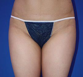 20代女性の脂肪吸引 Before 症例写真