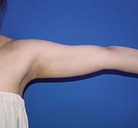 20代女性の脂肪吸引 Before 症例写真