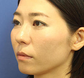 30代女性の3Dリポアイリフト  After 症例写真