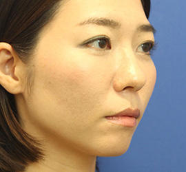 30代女性の3Dリポアイリフト  After 症例写真