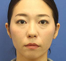 30代女性の3Dリポアイリフト Before 症例写真