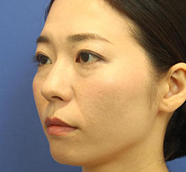 30代女性の3Dリポアイリフト  Before 症例写真