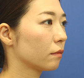 30代女性の3Dリポアイリフト  Before 症例写真