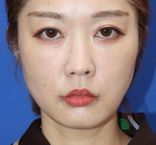 30代女性の口角挙上（スマイルリップ） After 症例写真