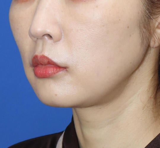 30代女性の口角挙上（スマイルリップ） After 症例写真