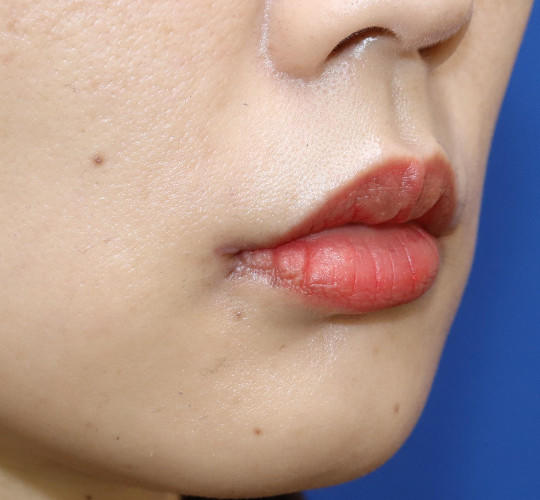 30代女性の口角挙上（スマイルリップ） After 症例写真
