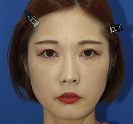 30代女性の顔の脂肪吸引  After 症例写真