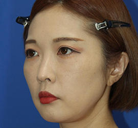 30代女性のシワ・たるみ After 症例写真