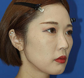 30代女性の顔の脂肪吸引  After 症例写真