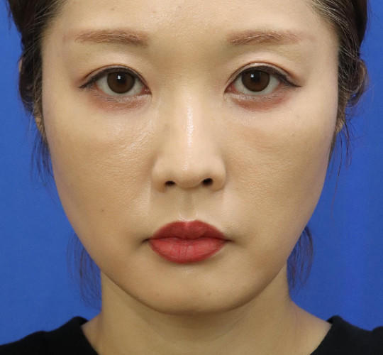 30代女性の口角挙上（スマイルリップ） Before 症例写真