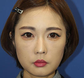 30代女性の顔の脂肪吸引  Before 症例写真