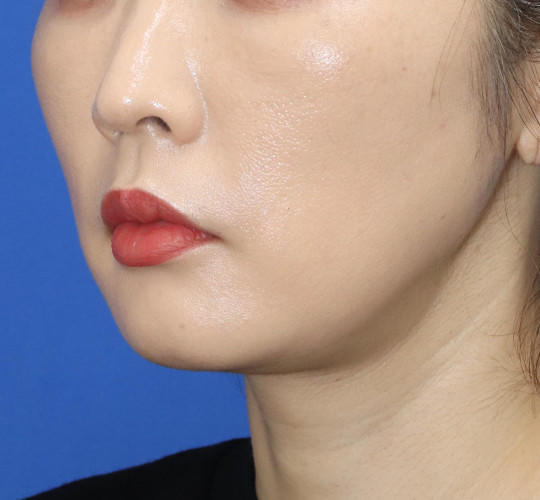 30代女性の口角挙上（スマイルリップ） Before 症例写真