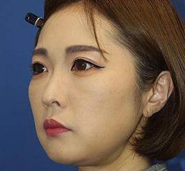 30代女性のシワ・たるみ Before 症例写真