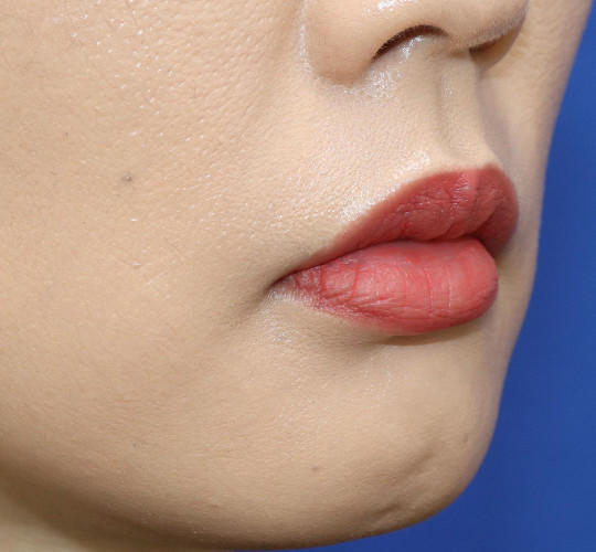 30代女性の口角挙上（スマイルリップ） Before 症例写真