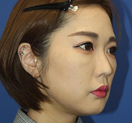 30代女性の顔の脂肪吸引  Before 症例写真