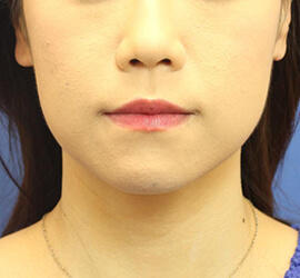 30代女性の After 症例写真