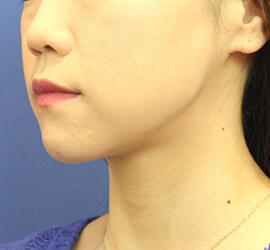 30代女性の After 症例写真