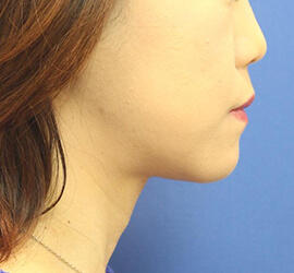 30代女性のシワ・たるみ After 症例写真