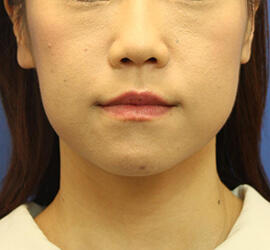 30代女性の Before 症例写真