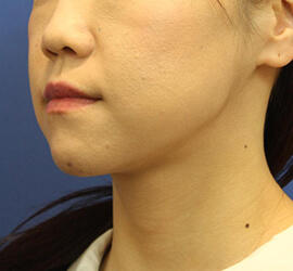 30代女性の Before 症例写真
