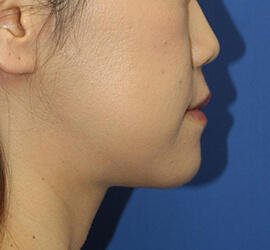 30代女性のシワ・たるみ Before 症例写真