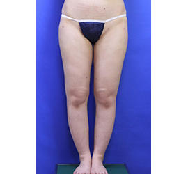 20代女性の脂肪吸引 After 症例写真