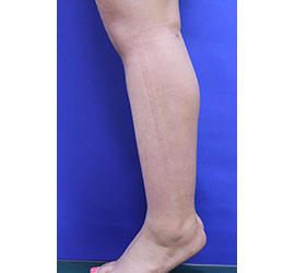 20代女性の脂肪吸引 After 症例写真