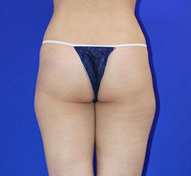 20代女性の脂肪吸引 Before 症例写真