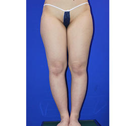 20代女性の脂肪吸引 Before 症例写真