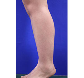 20代女性の脂肪吸引 Before 症例写真