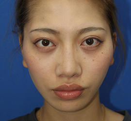 20代女性の3Dリポアイリフト  After 症例写真