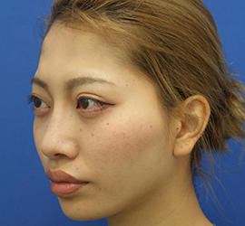 20代女性の3Dリポアイリフト  After 症例写真